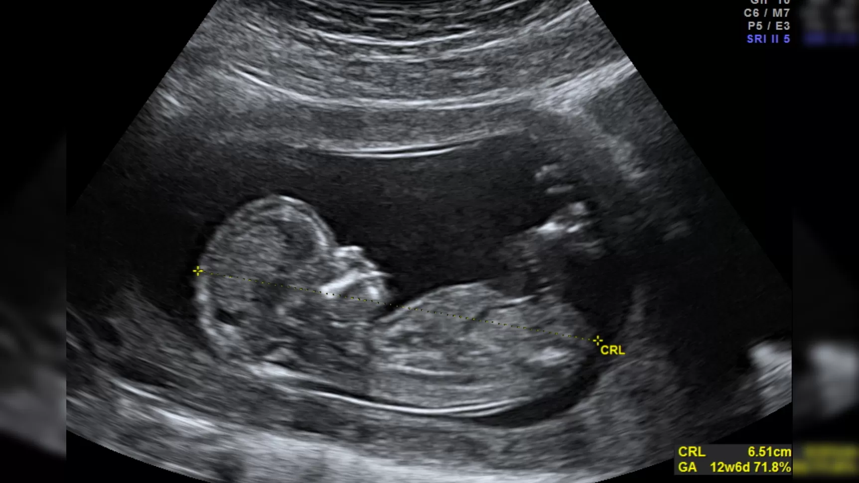 It’s More Important Than Ever to Listen to the Voices of Women Who Have Abortions
