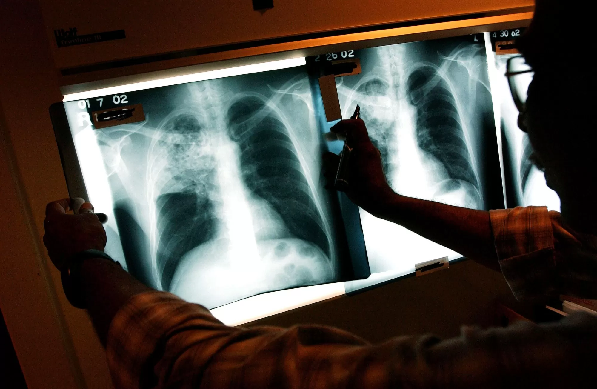 Why the Bay Area has been a tuberculosis hotspot for more than a century